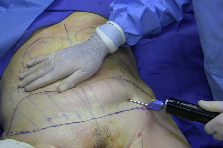 Cosmetic Surgery