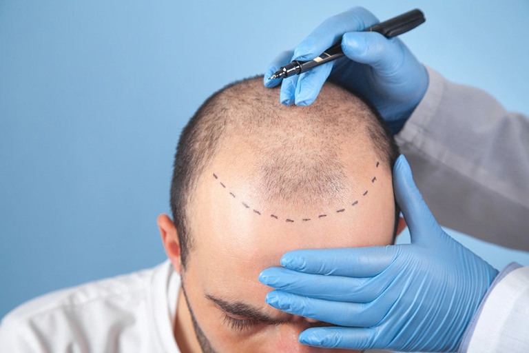 Hair Transplant